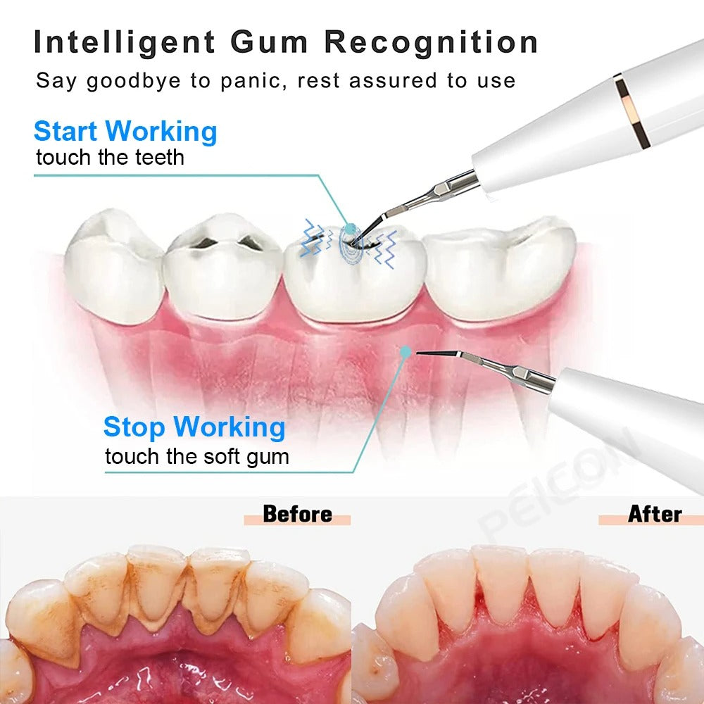 Ultrasonic Dental Scaler